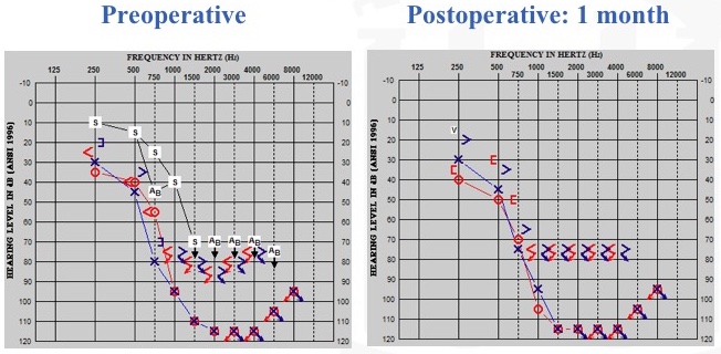 Residual hearing best-case scenario