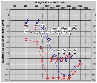 Low-frequency bone conduction pure tone average