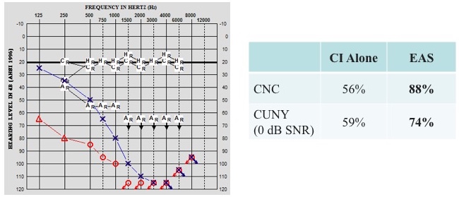 Case A low-frequency hearing