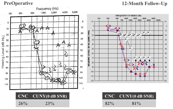Case B long-term stability