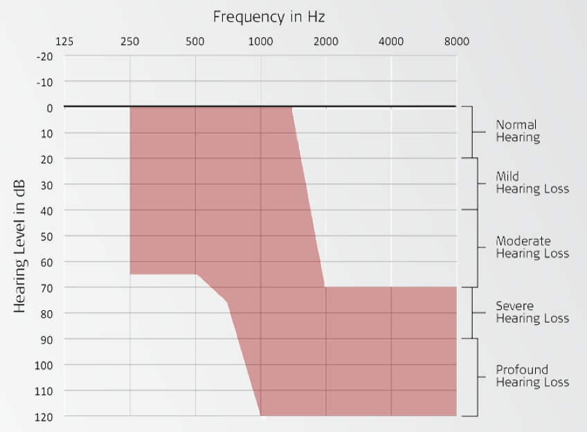 Candidacy inclusion criteria sample audiogram