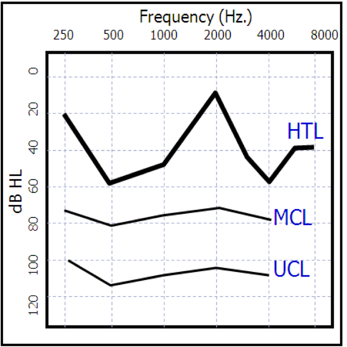 Irregular audiograms