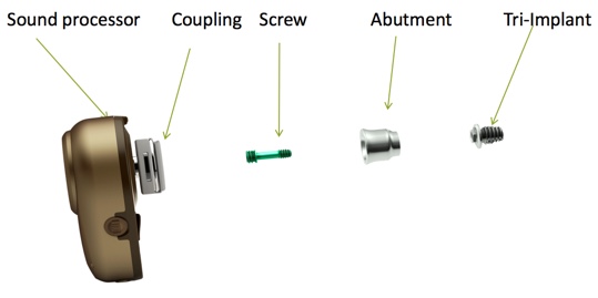 Components of BAHS devices and implant