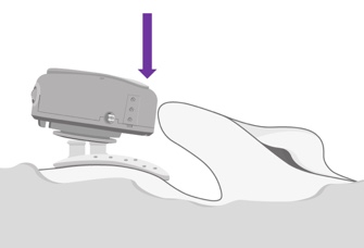 Detaching ADHEAR