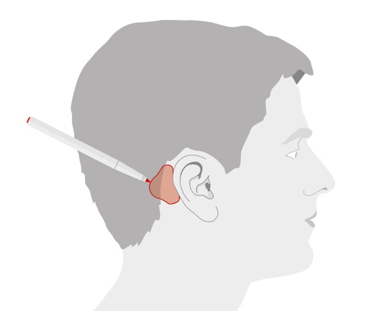 Optimal position for the adhesive adapter