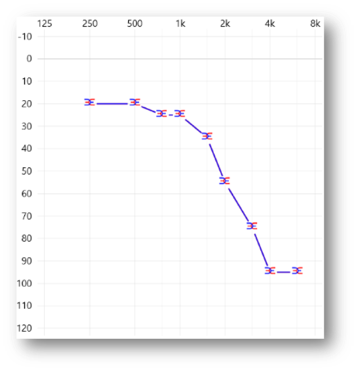 Audiogram of high-frequency hearing loss