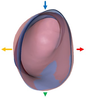 Comparison of right ear scan in pink and impression in blue
