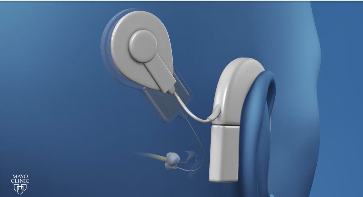 Cochlear implant