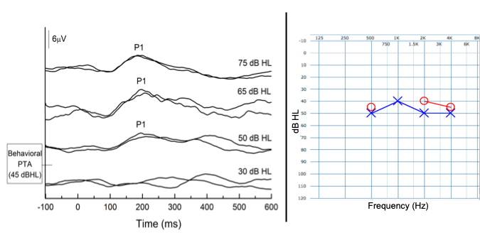 P1 CAEP biomarker threshold graph showing threshold at 50 dB HL side by side with pure tone audiogram with all thresholds between 40 and 50 dB HL .