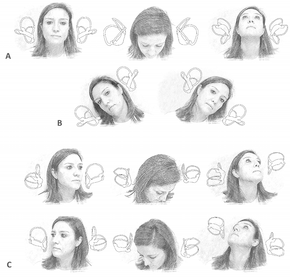 Upright BPPV protocol (UBP). 