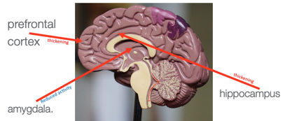 Thickened areas of the brain after mindfulness
