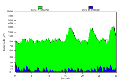 Biofeedback graph showing constipation