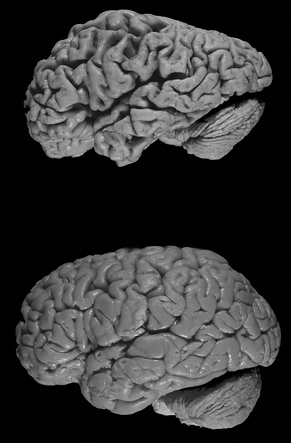 Healthy brain as compared to one in severe Alzheimer's
