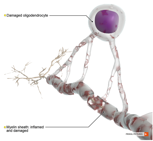 Damaged myelin sheath