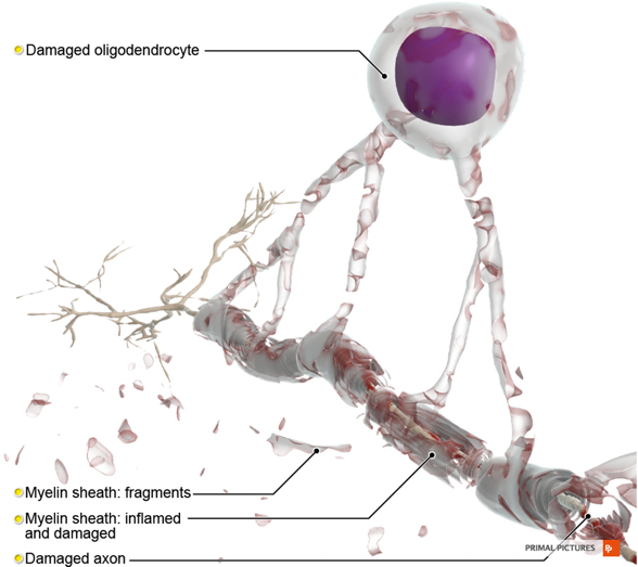 Further damage to the myelin sheath