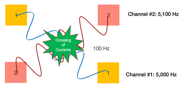 Example of interferential current