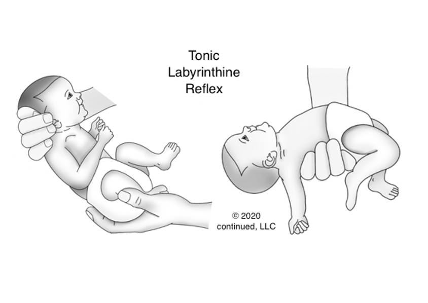 Drawing of the Tonic Labyrinthine reflex