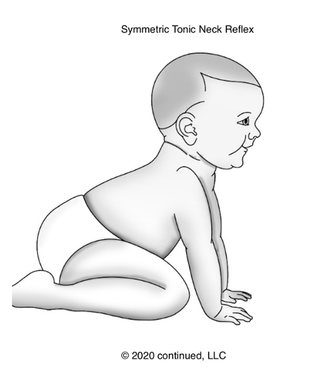 Drawing of the STNR reflex