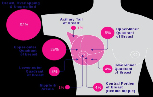 locations of breast cancer occurrences graphic