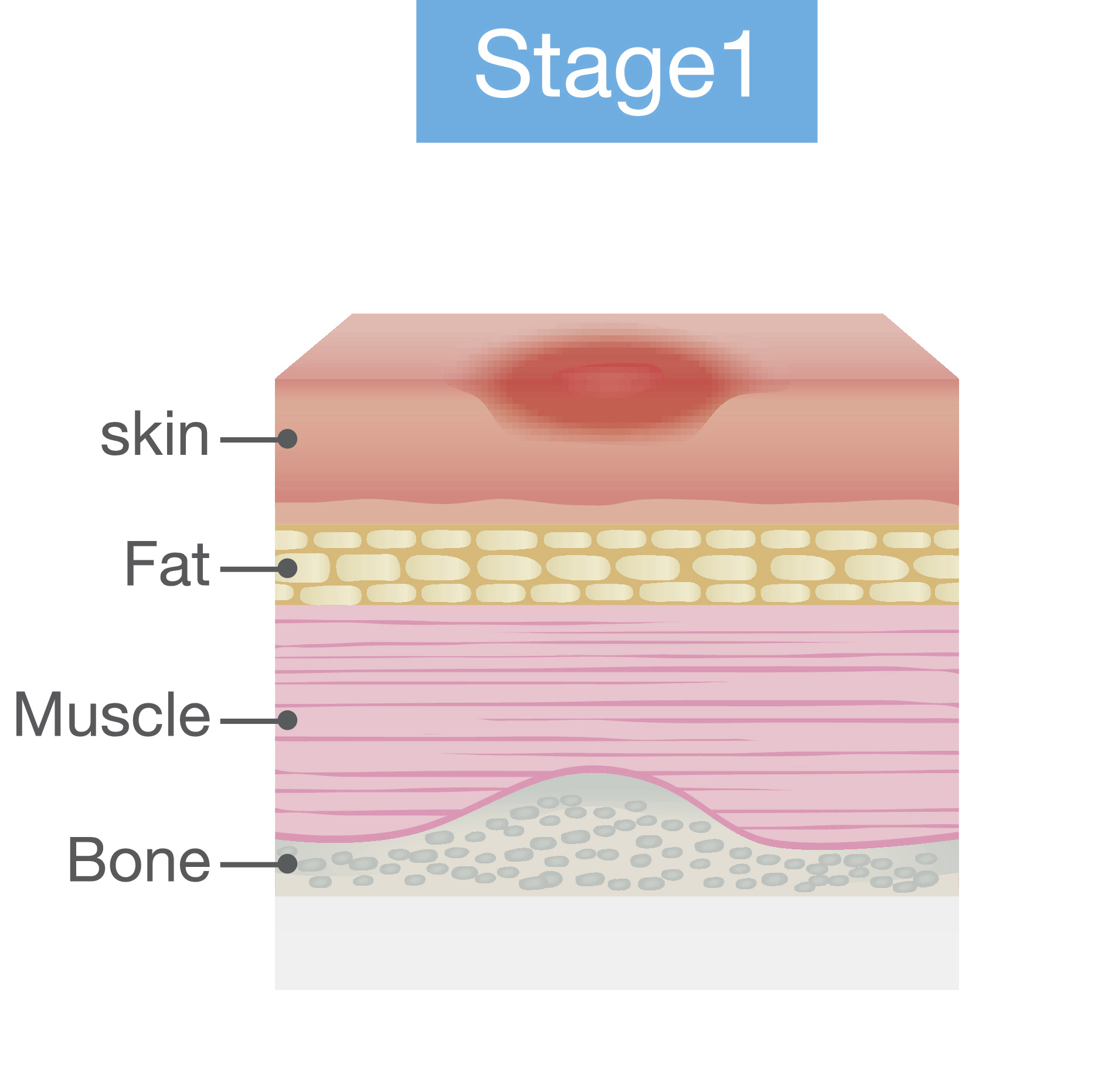 Stage 1 pressure injury
