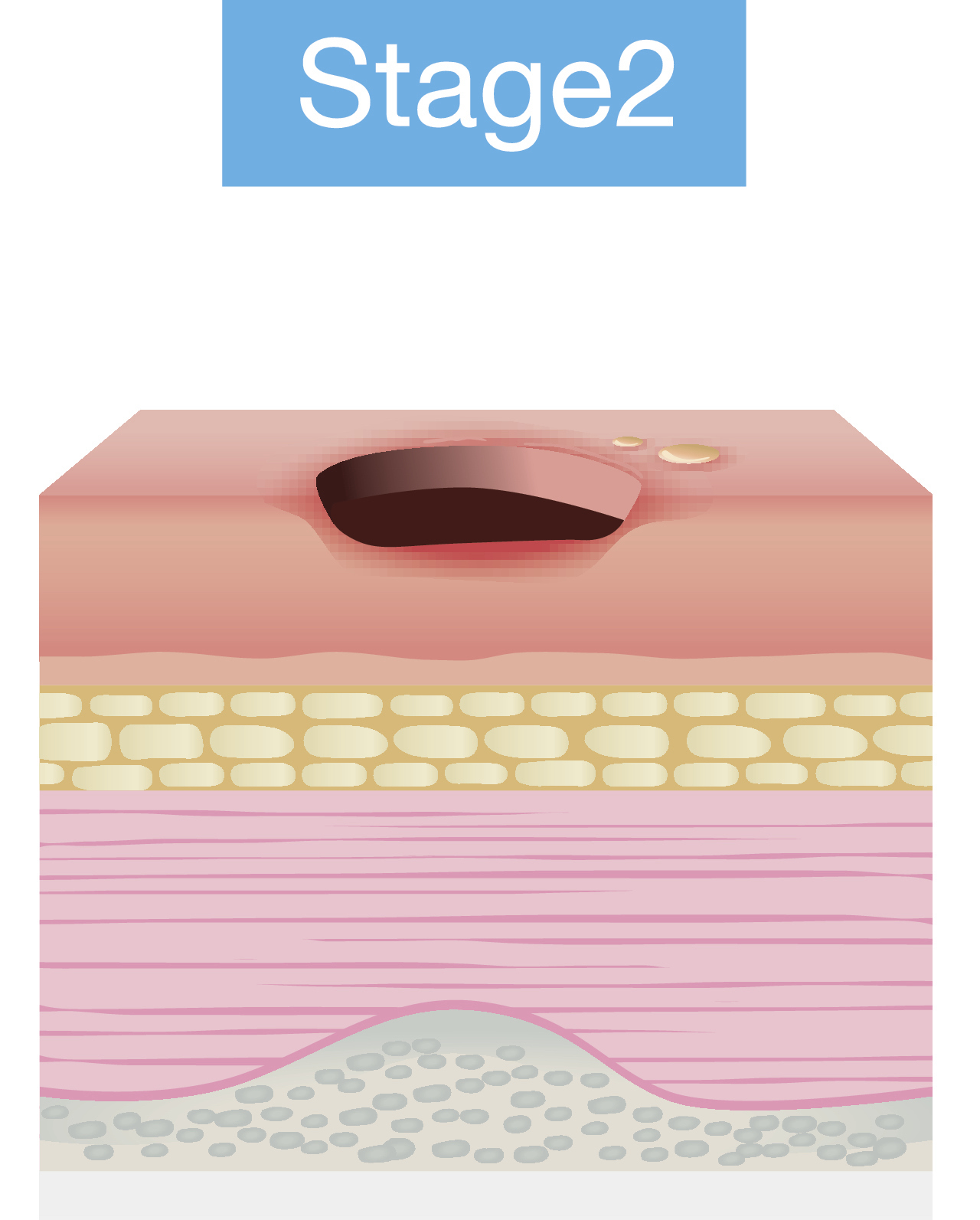 Stage 2 pressure injury