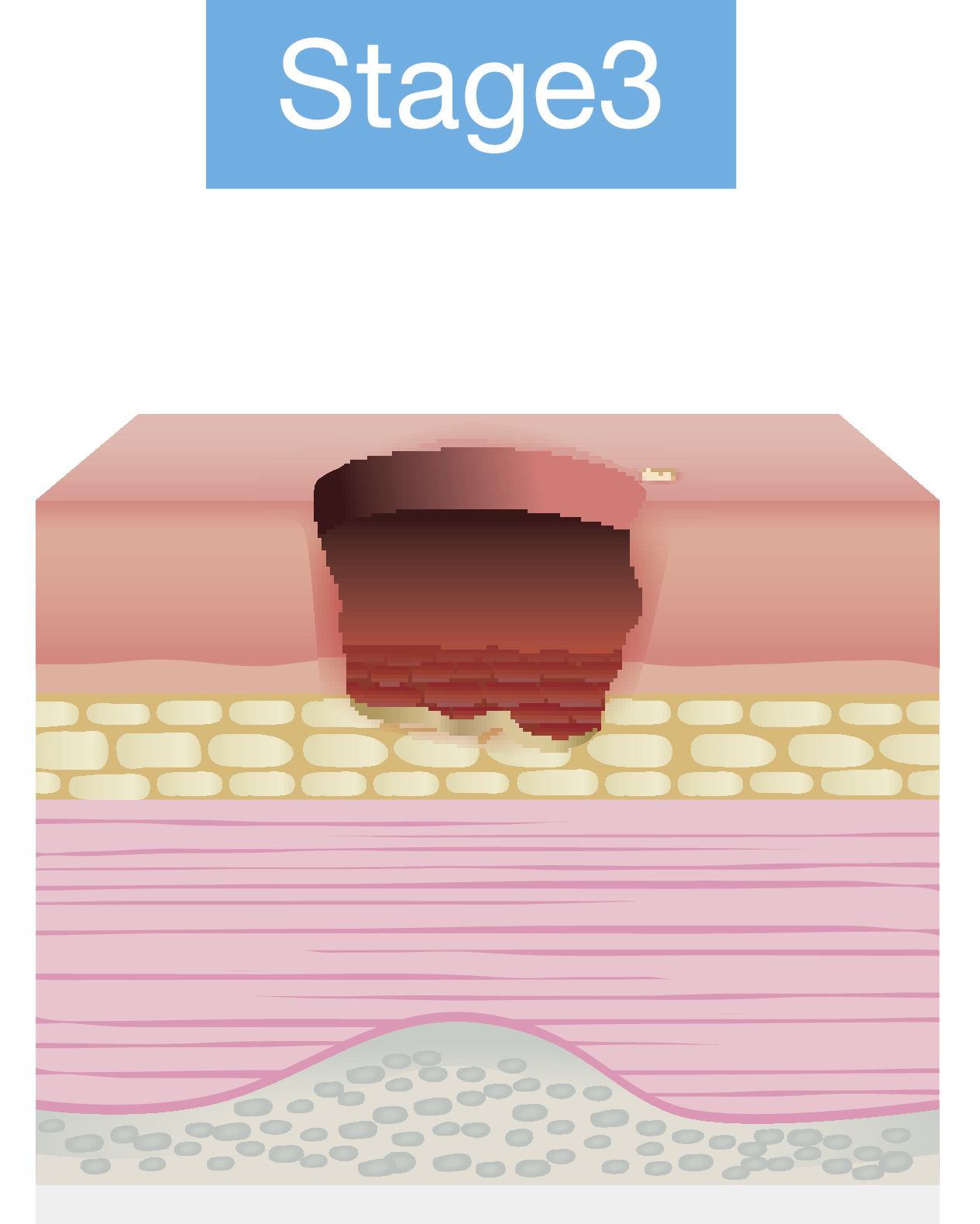 Stage 3 pressure injury