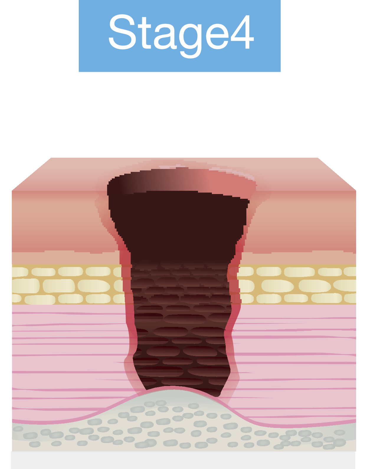 Stage 4 pressure injury