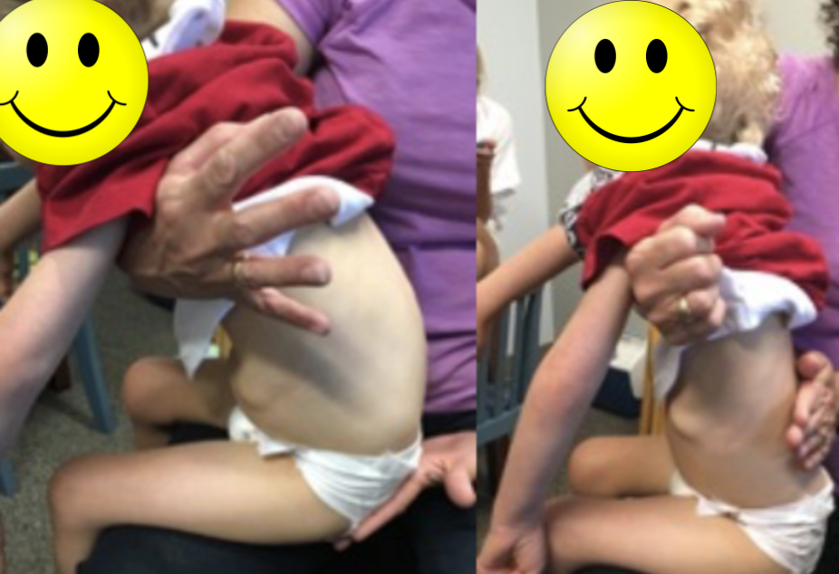 Rounded back is corrected by the therapist for increased head and neck position