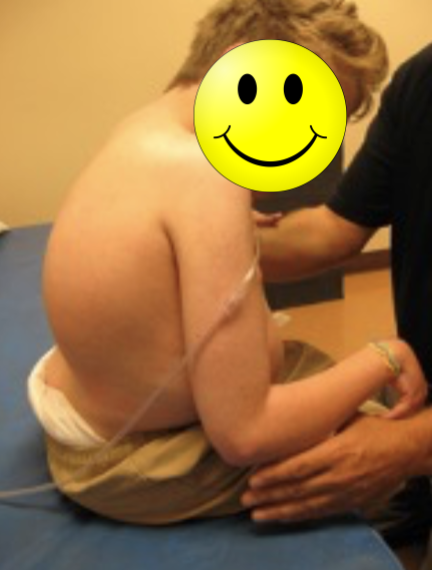 Client with severe curvature and rotation of the spine to the right