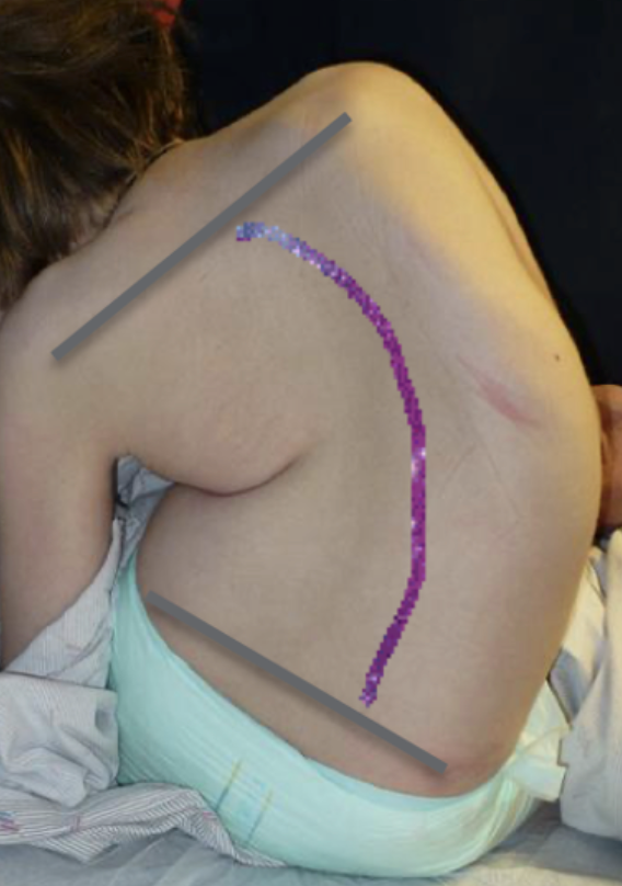 This child has severe pelvic obliquity and resultant lateral sclerosis with a C curve to the right side.