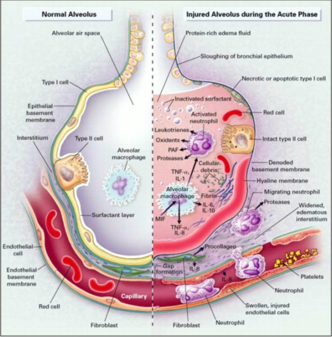 The normal alveolus (Left-Hand Side) and the injured alveolus in the acute phase of acute lung injury and the acute respiratory distress syndrome (Right-Hand Side) Date